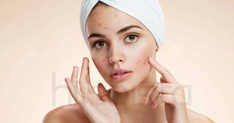 Perkongsian 10 Hijabi Yang Ada Masalah ‘Breakout’, Akhirnya Sembuh Setelah Try & Error Pelbagai Prodduk