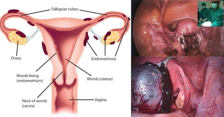 Wanita Alami Senggugut Sampai Berguling-Guling Wajib Risau, Sebabnya Salah Satu Tanda Hidap Endometriosis