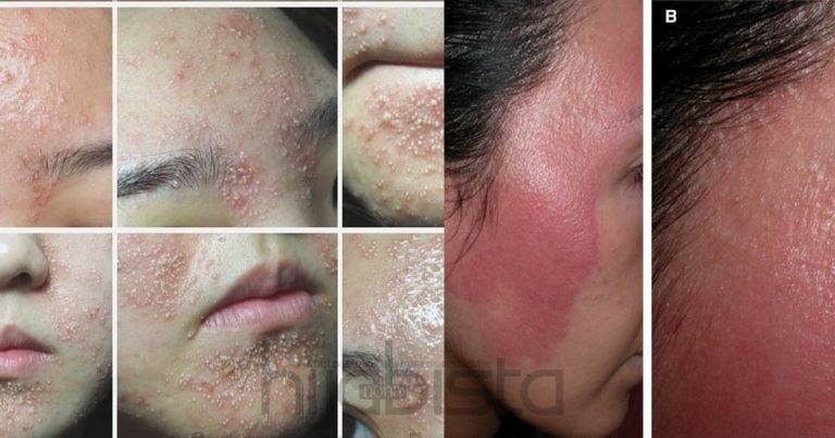 TAKUTNYA Bahaya Petua Cantik ‘HOMEMADE’, DOKTOR Kata Boleh Akibatkan Wajah Jerawat, NANAH & Terbakar