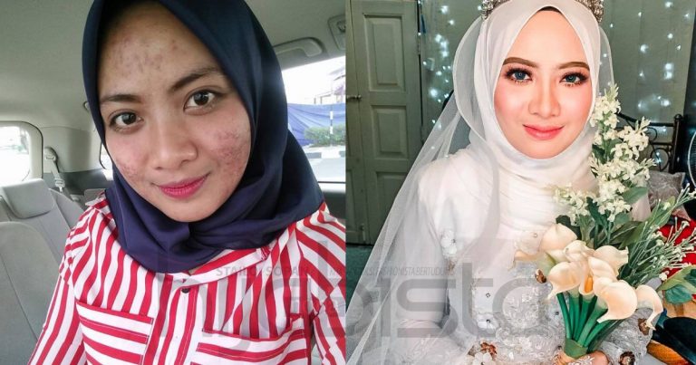 Bakal Pengantin Boleh Cuba Cara Gadis Ini Pulihkan Wajah Dari Breakout Teruk Dengan Bermodalkan RM300