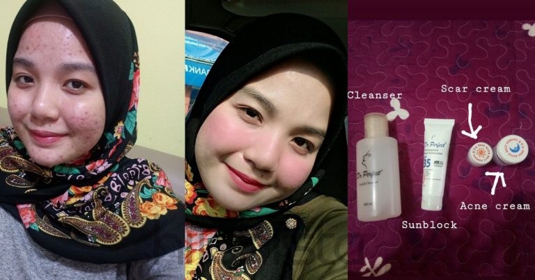 Terseksa Sebab Jerawat Merah, Gadis ini Akhirnya Pulih Lepas 4 Bulan Guna Produk Farmasi