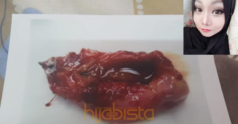 “Dulu Saya Degil, Kini Hempedu Saya Terpaksa Dibuang Gara-Gara Produk Timbang Kilo”