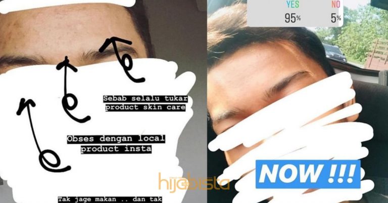 Dulu Berjerawat Pasir, Lelaki Ini Kongsi Tip Kulit Flawless Hasil Guna Produk Murah Dari Drugstore