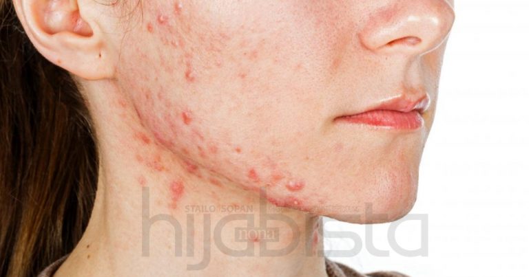 Perubahan Hormon Punca Kenapa Jerawat Selalu Tumbuh Kat Pipi & Dahi. Hijabi Perlu Ambil Tahu!