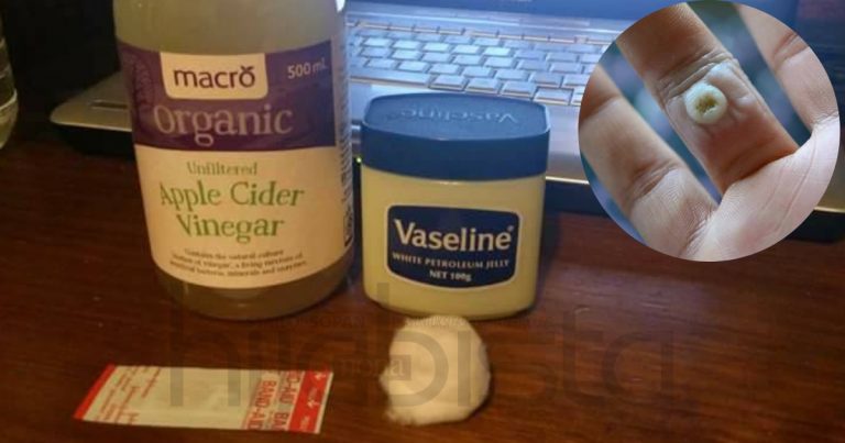 Wanita Ini Kongsi Buang Ketuat Dengan Cepat Hanya Guna 4 Bahan Dapur. Rugi Sangat Kalau Tak Cuba!