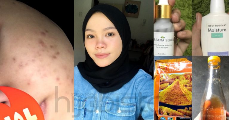 Gadis Ini Kongsi Cara Penjagaan Kulit Wajah Yang Betul & Produk Sesuai Untuk Atasi Masalah Jerawat, Breakout